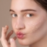 5 Dicas para Remover Manchas do Rosto