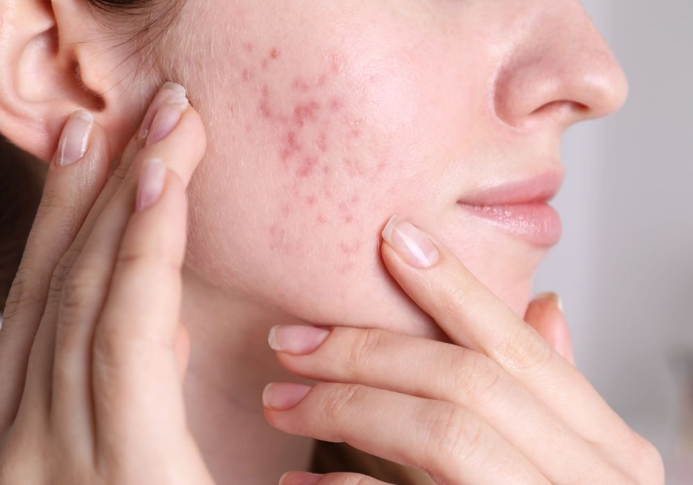 Como Usar Ácidos para Tratar Acne com Segurança