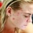 Quais Ácidos São Indicados para Tratar Acne Conheça os Mais Eficazes
