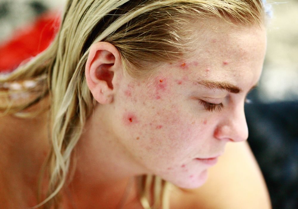Quais Ácidos São Indicados para Tratar Acne Conheça os Mais Eficazes