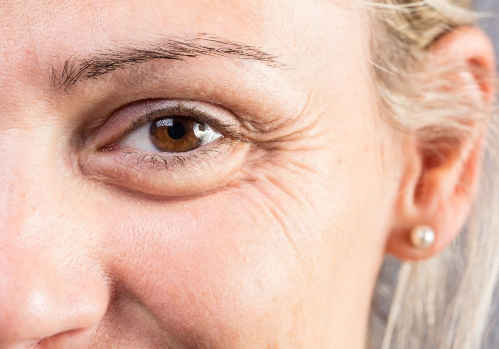 Rugas na Testa e ao Redor dos Olhos Como Tratar de Forma Segura e Eficaz