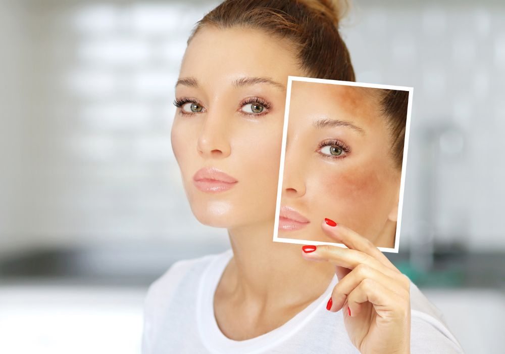 Clareador de Melasma Guia para Conhecer o Melhor Clareador de Melasma